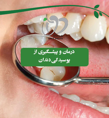 درمان و پیشگیری از پوسیدگی‌ دندان