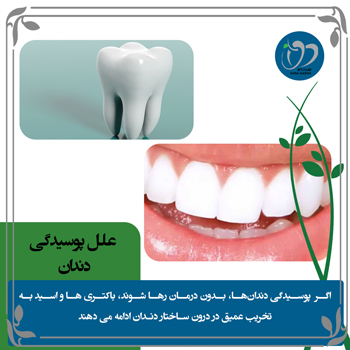 علل پوسیدگی دندان